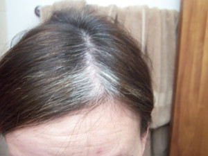 hair loss